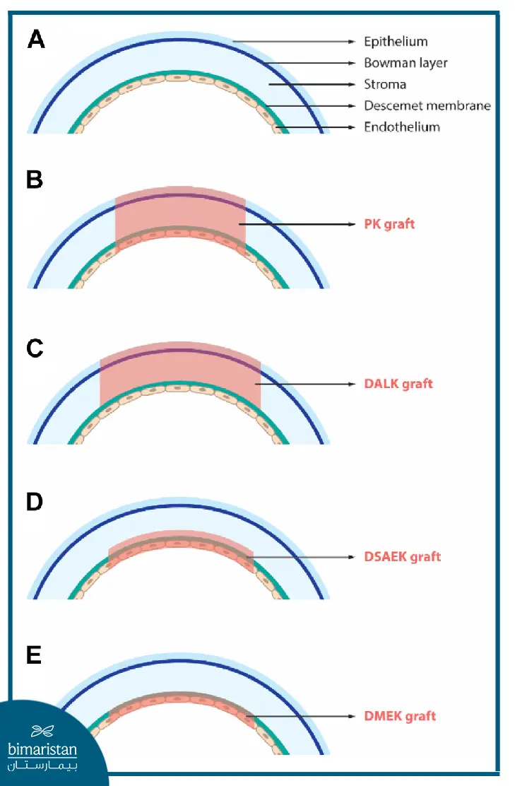 An Image Showing The Types Of Corneal Transplantation In Türkiye