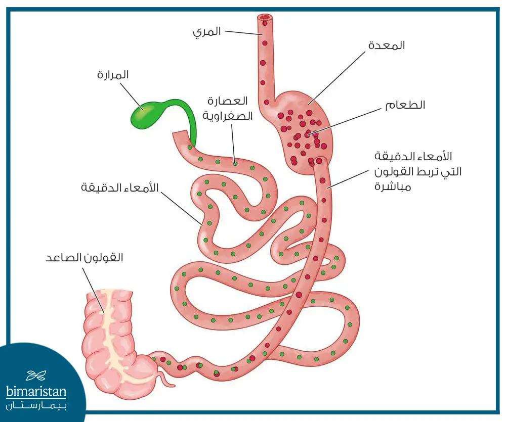 بقايا الأمعاء بعد تحويل مسار البنكرياس والقنوات الصفراوية مع تحويل الاثني عشر