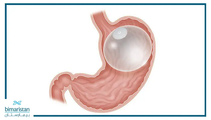 شكل بالون المعدة بعد تركيبه وامتلائه بالسائل الملحي