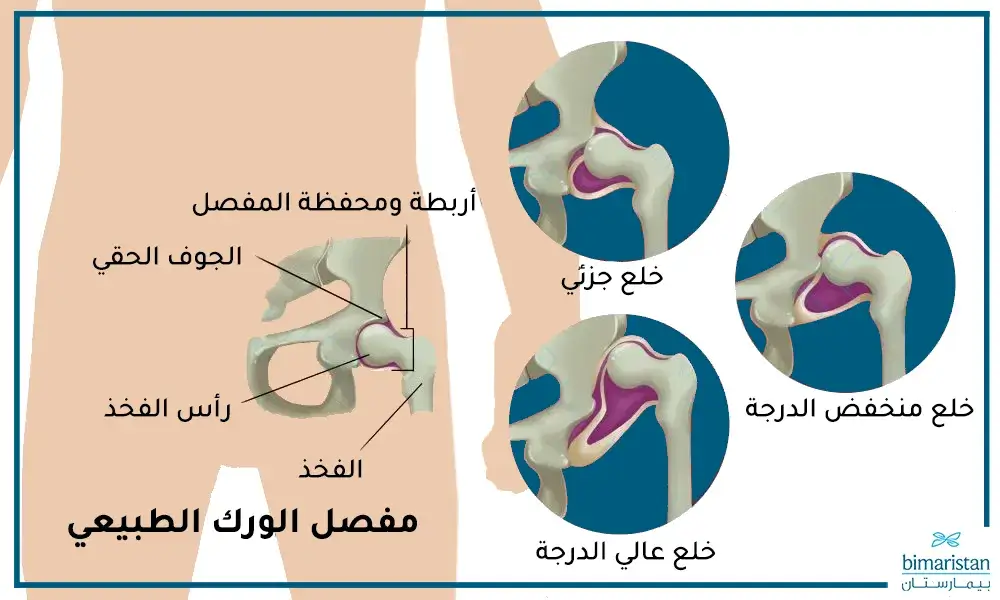 كلما كان خروج رأس الفخذ من الجوف الحقي أكبر كانت درجة الخلع أعلى