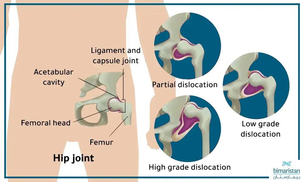 The Greater The Displacement Of The Femoral Head From The Acetabulum, The Higher The Degree Of Dislocation.