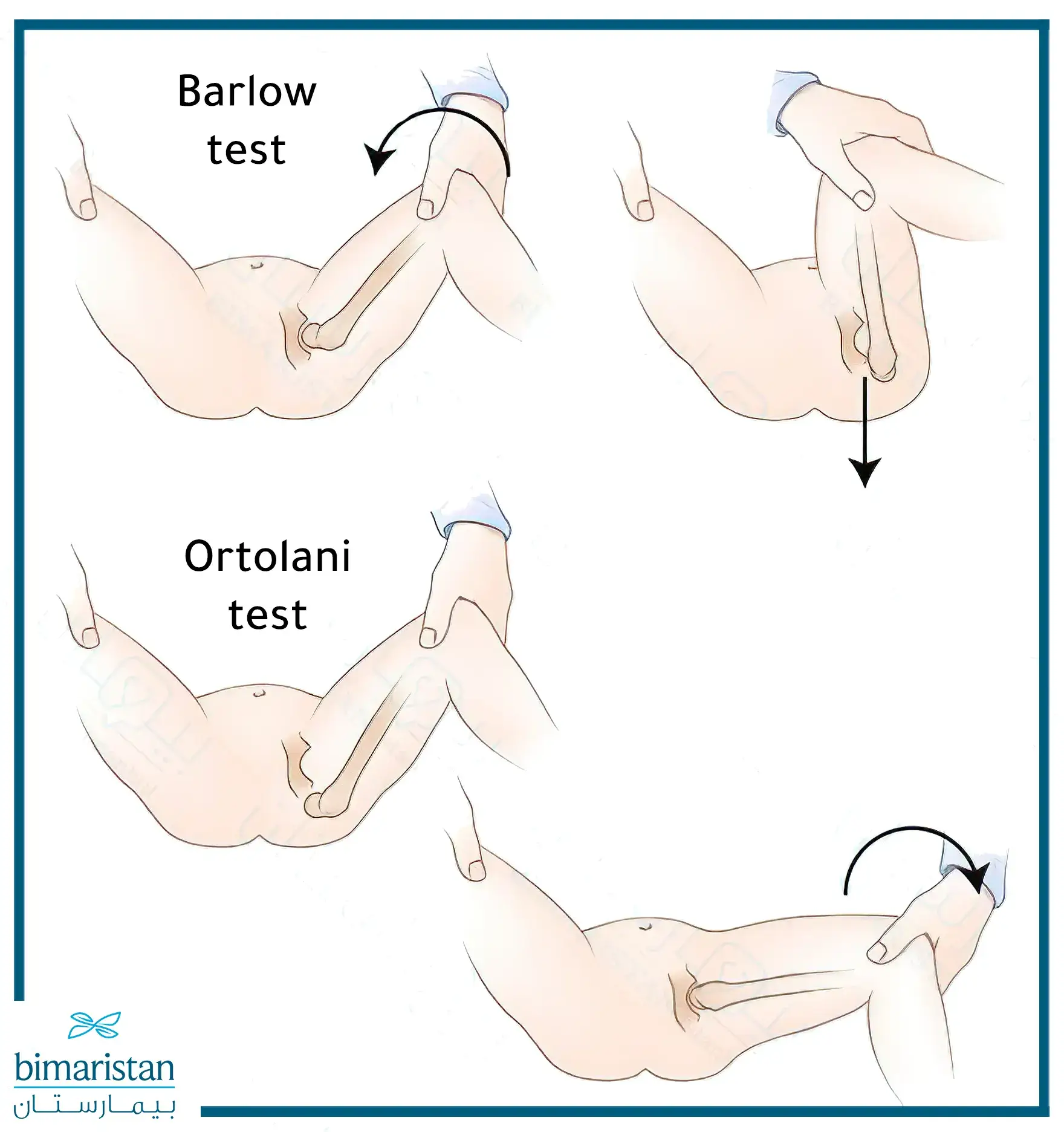 Method Of Performing The Barlow Maneuver And The Ortolani Maneuver For Treating Congenital Hip Dislocation