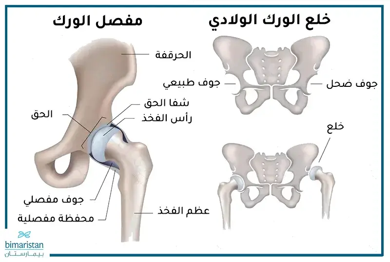 مقارنة بين جوف الحق في مفصل الورك الطبيعي وبين الجوف الضحل الذي قد يكون السبب في حدوث خلع الورك الولادي