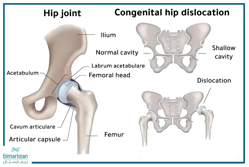 Comparison Between The Depth Of The Acetabulum In The Normal Hip Joint And The Shallow Acetabulum, Which May Be The Cause Of Congenital Hip Dysplasia