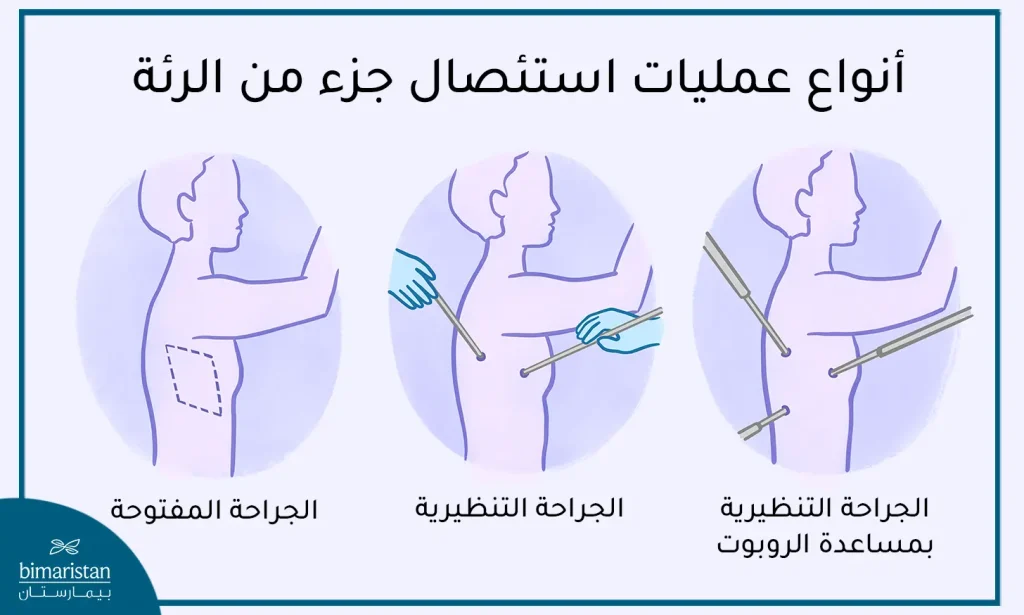 طرق إجراء عملية استئصال جزء من الرئة في تركيا