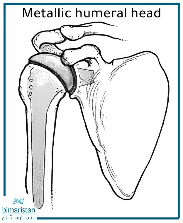 Artificial shoulder joint

