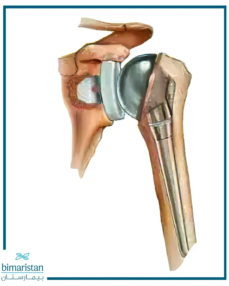 Shoulder joint replacement in Turkey with an artificial joint

