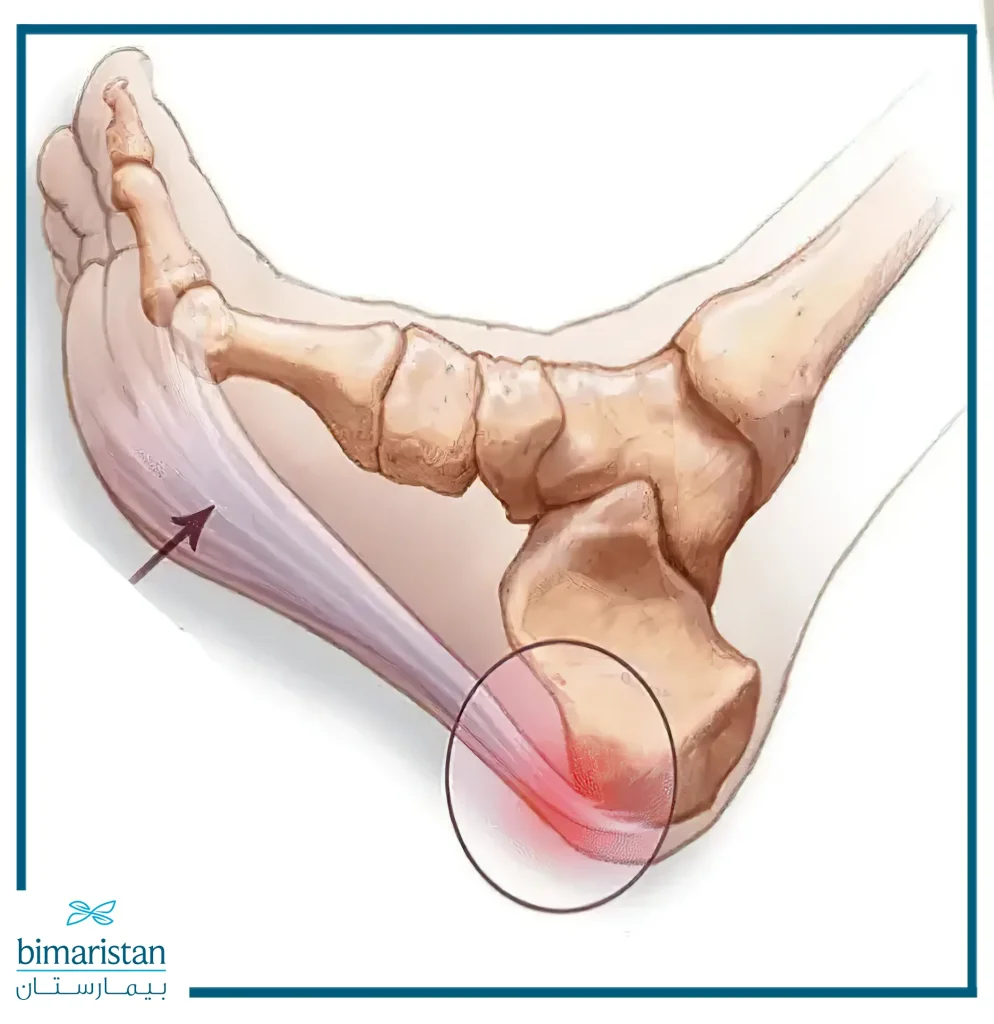 Any Ligament Tear Can Cause Plantar Fasciitis