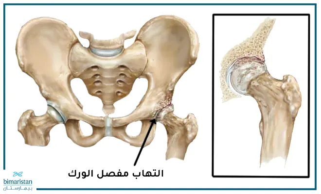 التهاب مفصل الورك بالصور