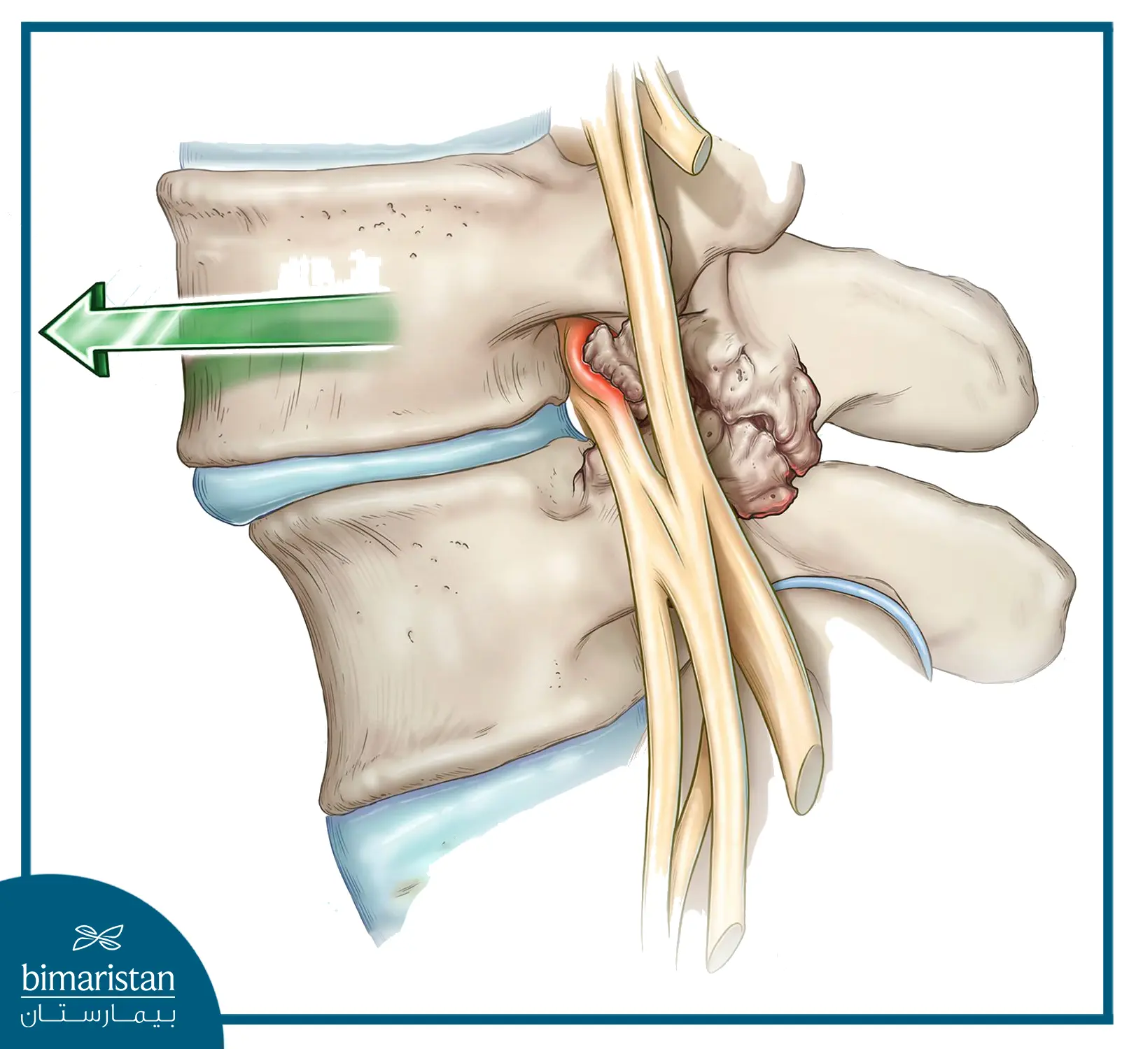 Image Illustrating The Mechanism That Causes The Symptoms Of Slipped Lumbar Disc