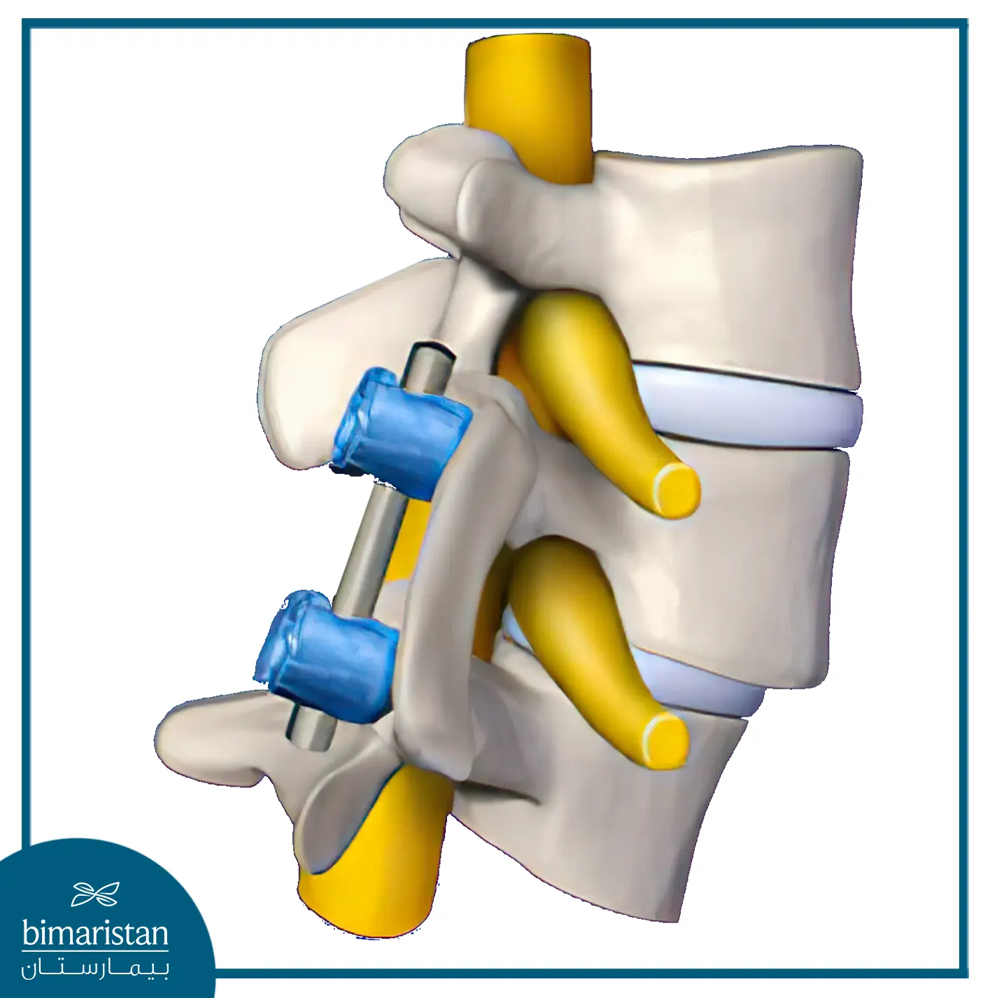 Treatment Of Lumbar Spondylolisthesis Through Spinal Stabilization






