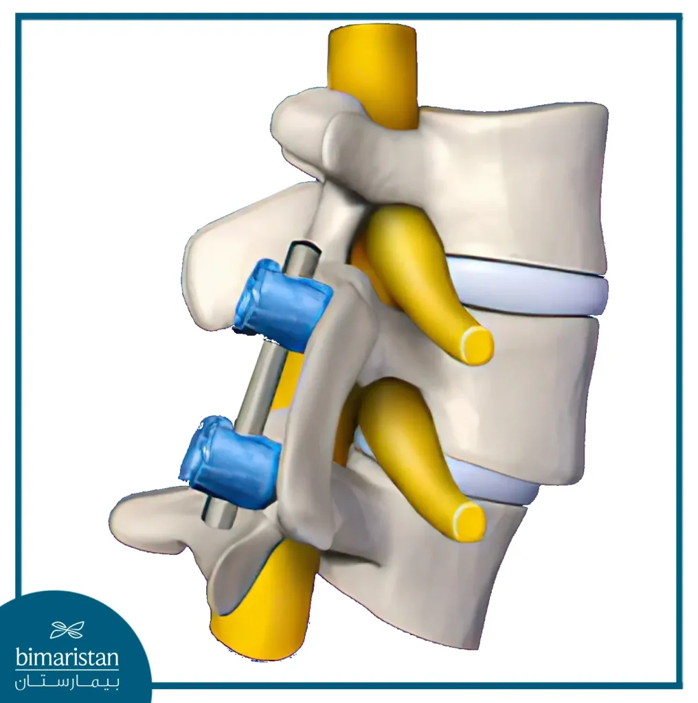 علاج انزلاق الفقرات القطنية عبر تثبيت العمود الفقري