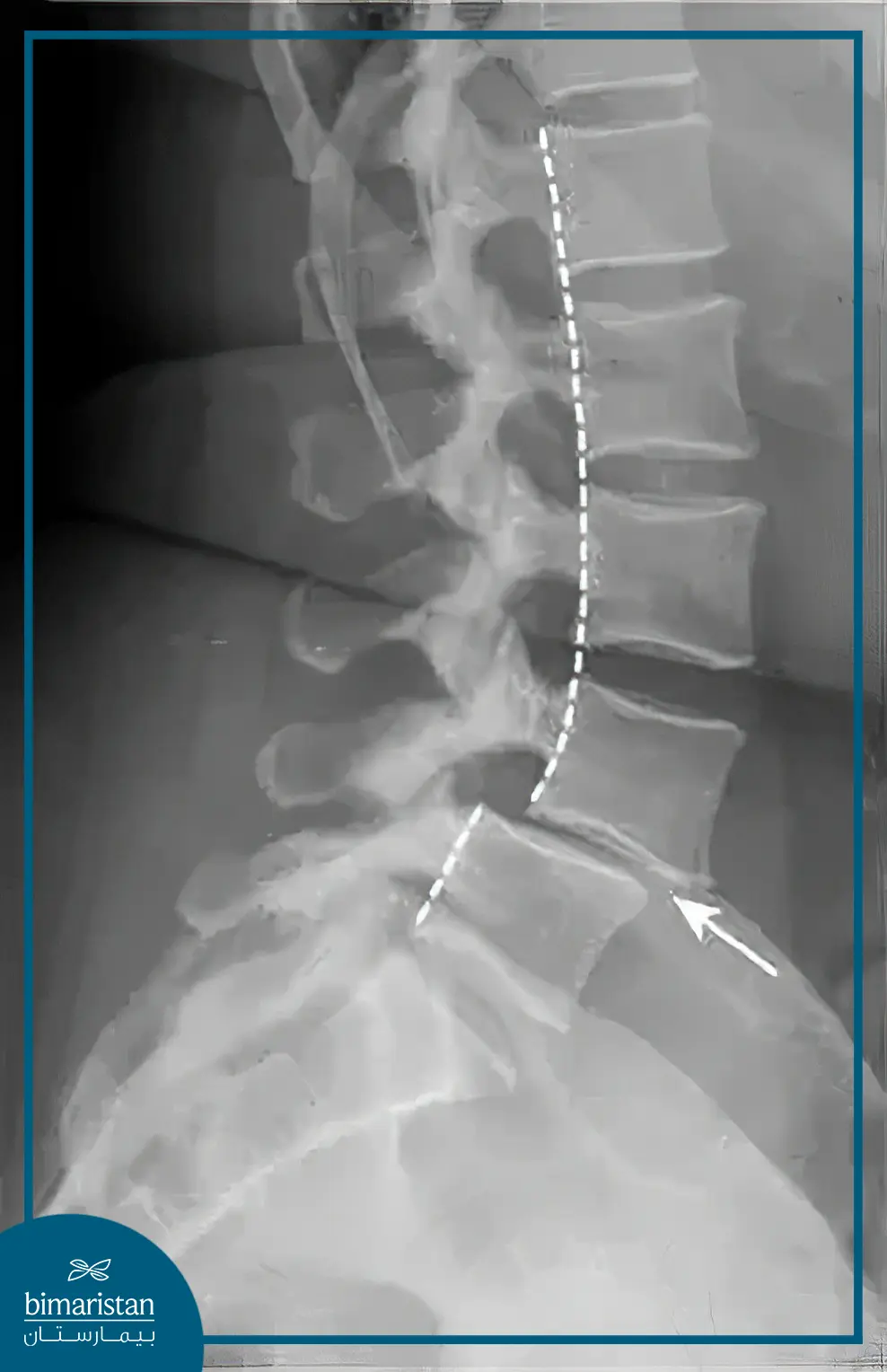 An Image Showing Lumbar Spondylolisthesis On X-Ray
