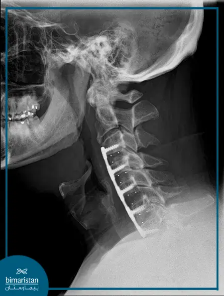 صورة شعاعية توضح عملية تثبيت الفقرات المستخدمة في علاج انزلاق فقرات الرقبة