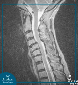 Cervical Disc Herniation On Mri Image.