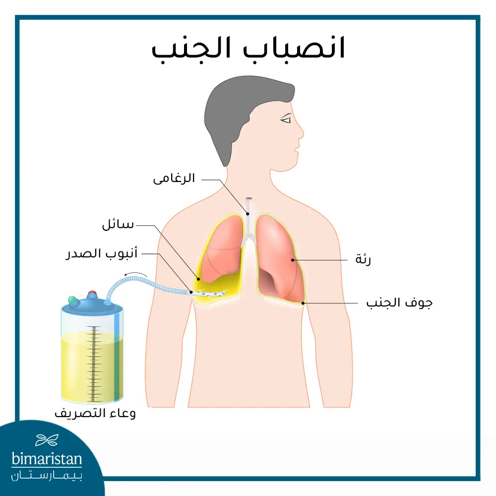 علاج الانصباب الجنبي عبر أنبوب تصريف السوائل (تفجير الصدر)