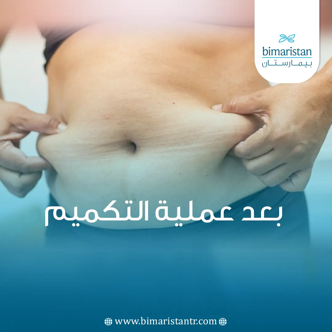 بعد عملية التكميم
