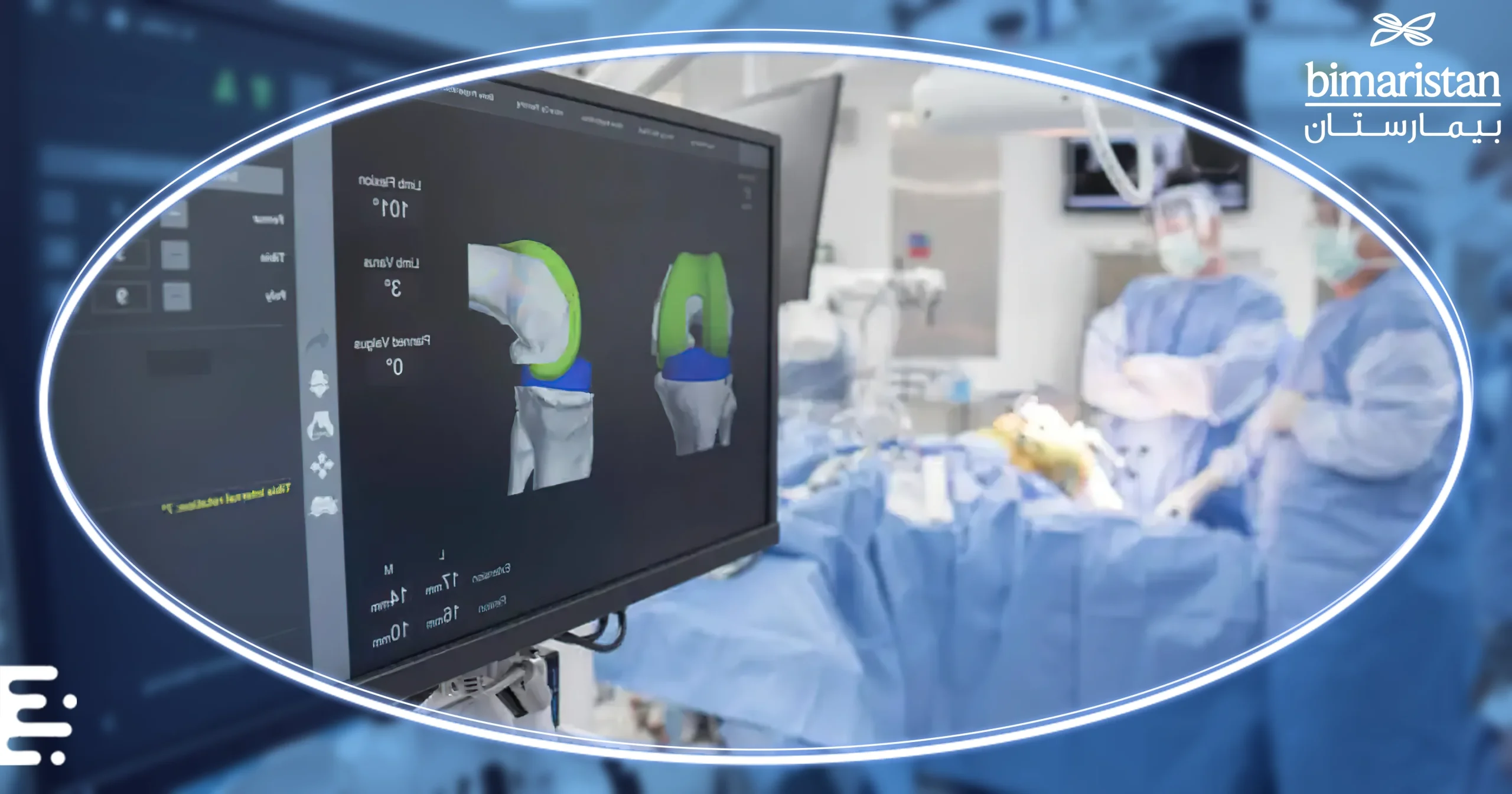 A picture illustrating the planning of the knee joint during the robotic knee replacement surgery
