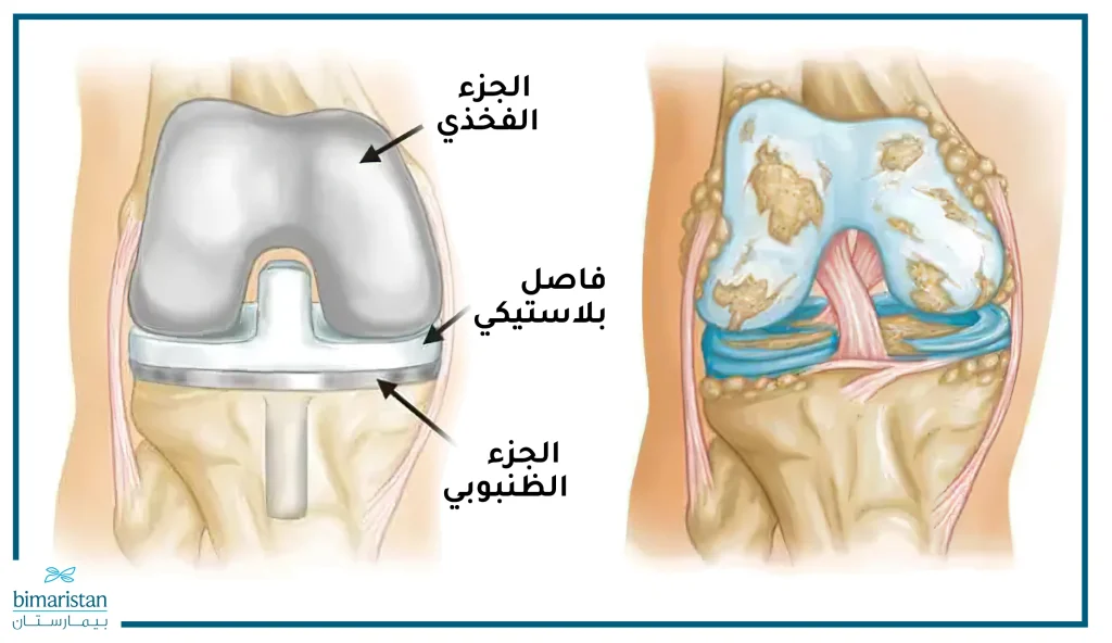 صورة تبين مفصل الركبة المهترئ قبل العملية مقارنة مع المفصل الجديد المركب روبوتياً
