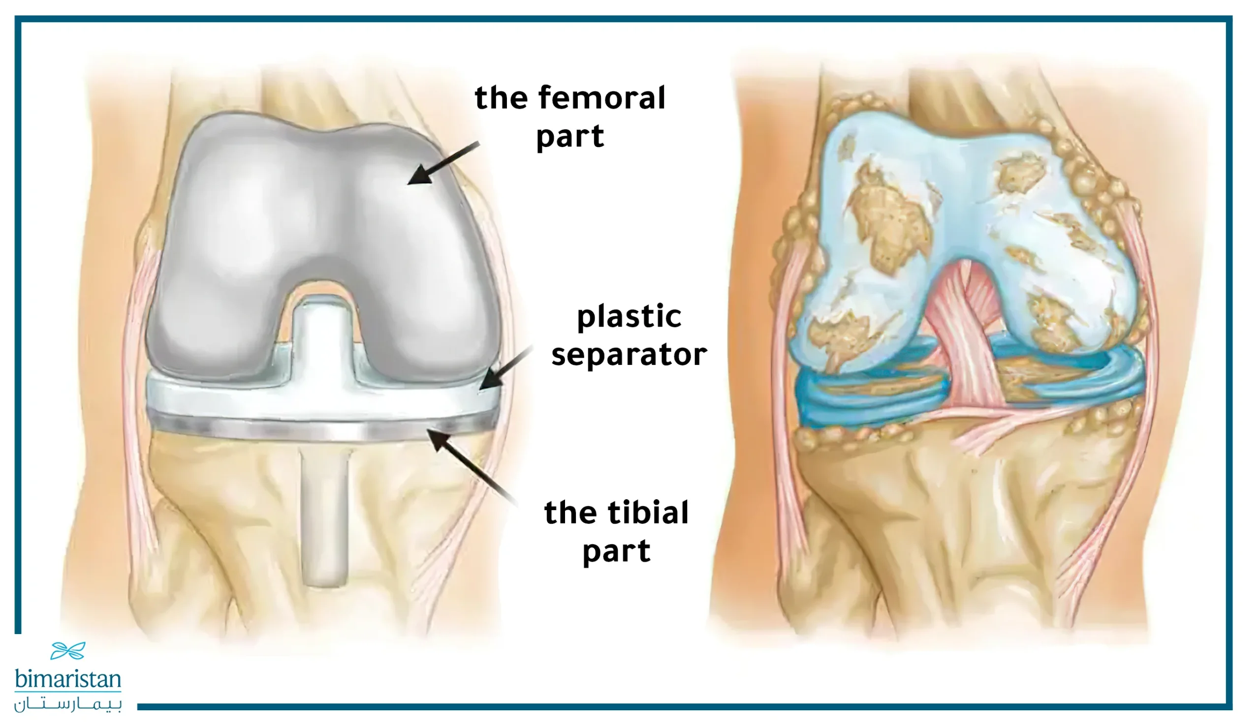 A picture showing the worn-out knee joint before the surgery compared to the new joint installed robotically.
