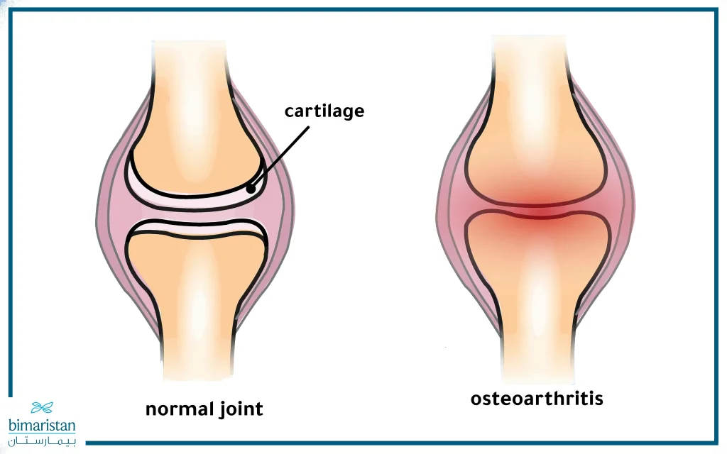 Osteoarthritis Can Lead To Joint Stiffness, Particularly In The Knees.