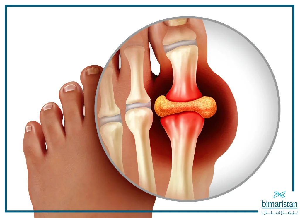 Stiffness Of The Big Toe Joint Is One Of The Most Common Symptoms Of Gout.