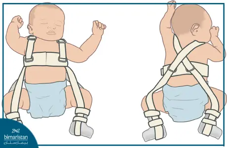 Splint Pavlik Is Used To Stabilize The Hip Joint In Children With Congenital Hip Dislocation