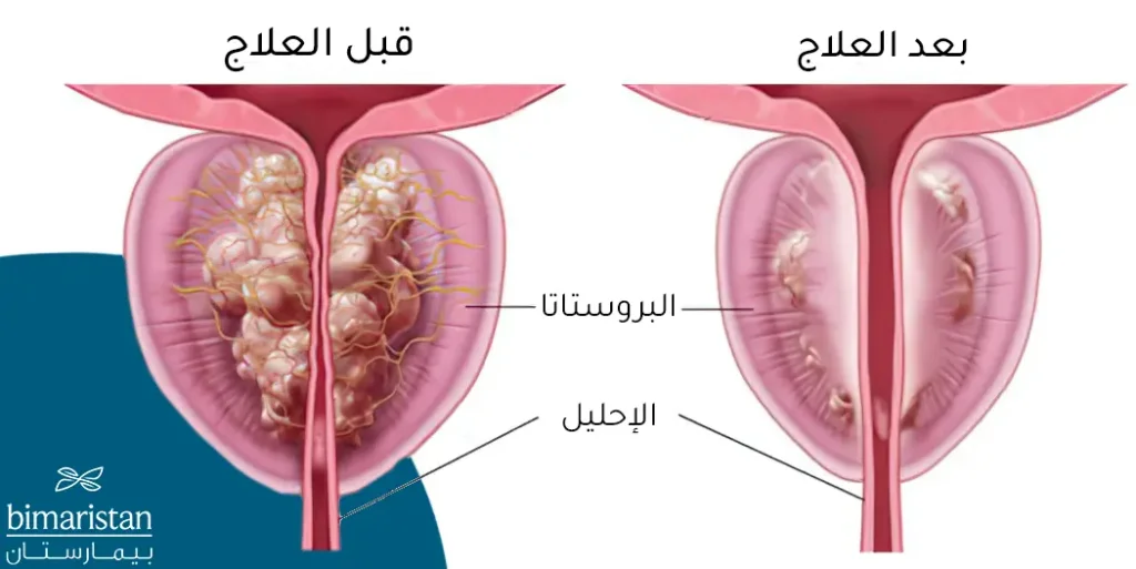 قبل وبعد علاج تضخم البروستاتا في تركيا