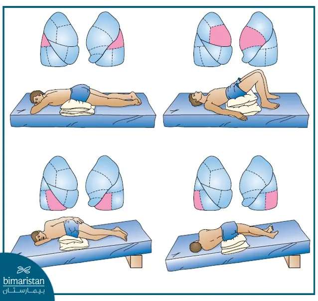 علاج خراج الرئة بواسطة العلاج الفيزيائي التنفسي
