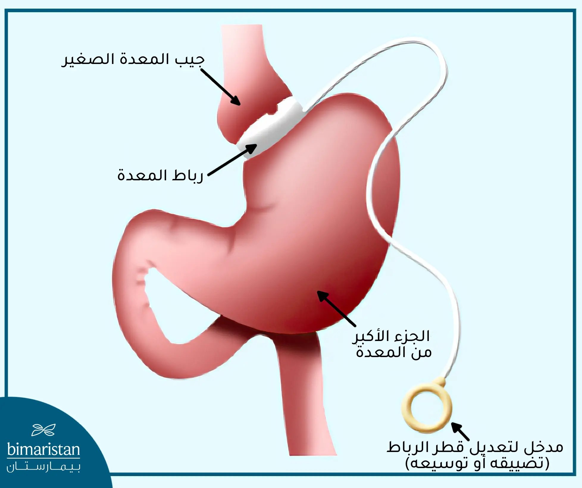 طريقة إجراء عملية ربط المعدة بالمنظار