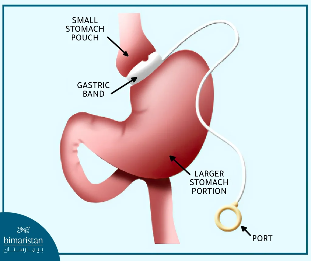 Laparoscopic Gastric Banding Cost In Turkey 2025: Your Full Guide To Prices &Amp; Benefits 2 Laparoscopic Gastric Banding Cost In Turkey: What The Stomach Looks Like After Laparoscopic Gastric Banding