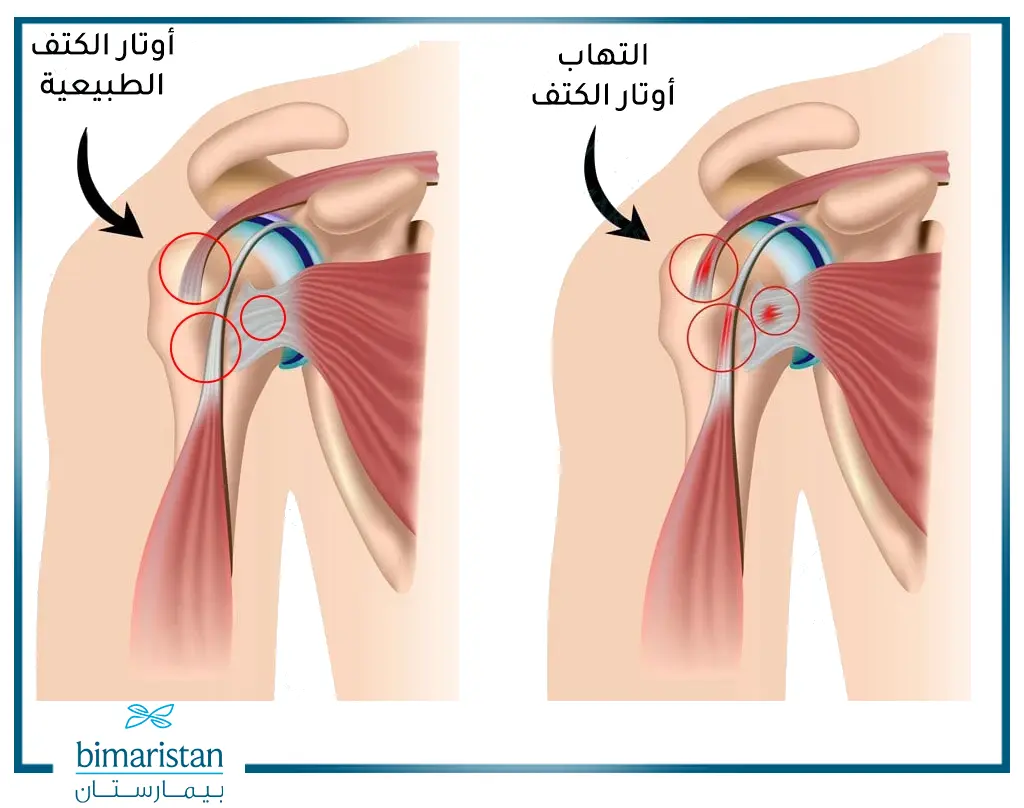 رسم توضيحي يقارن بين حالة التهاب أوتار الكتف والأوتار الطبيعية