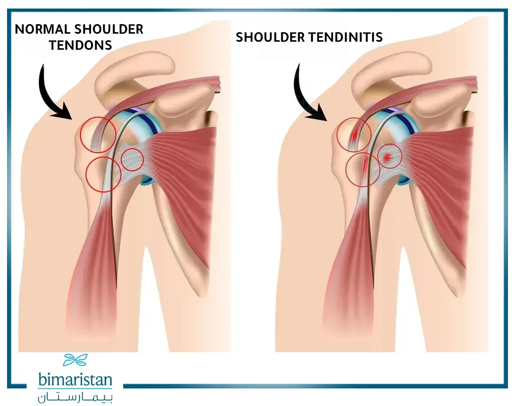 Illustration Comparing Between A Condition Of Shoulder Tendonitis And The Normal Tendons.

