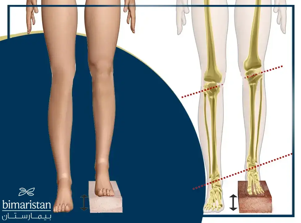 A Picture Illustrating Leg Length Discrepancy