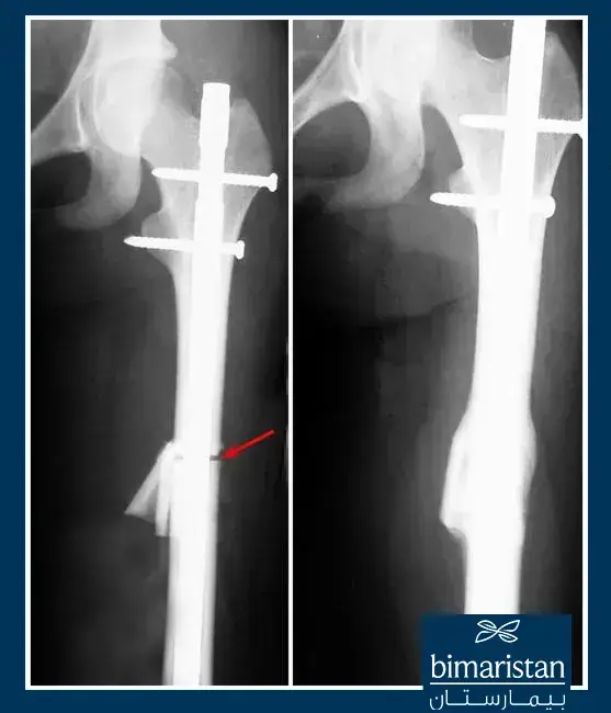 An X-Ray Image Illustrating Leg Shortening Surgery In Turkey