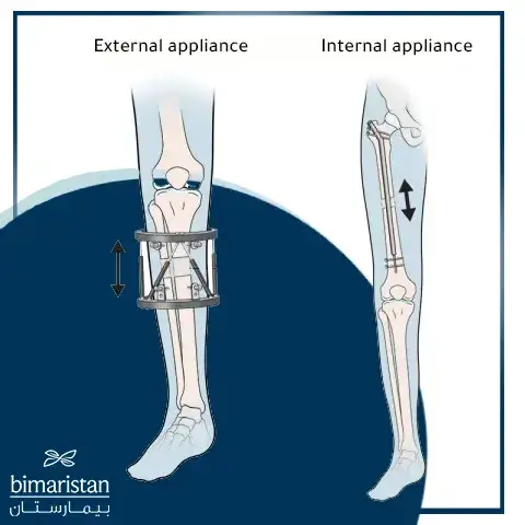 Internal Limb Lengthening Device And External Limb Lengthening Device For Treating Leg Length Discrepancy