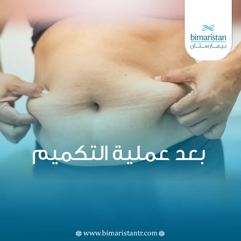 بعد عملية التكميم