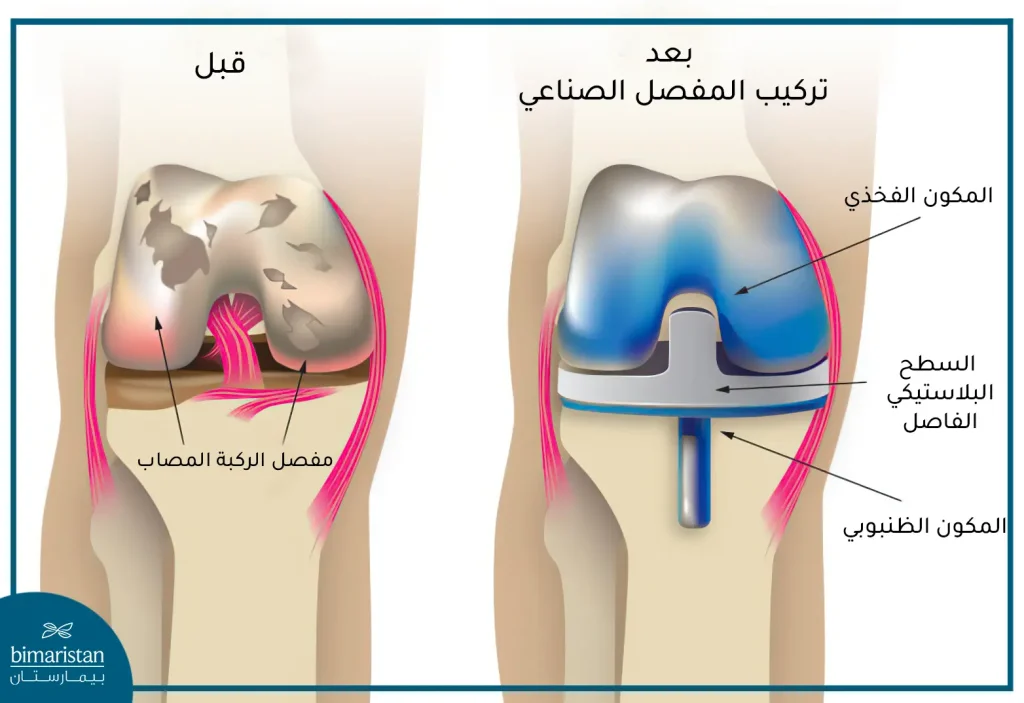 قبل وبعد تركيب أحد أنواع مفصل الركبة الصناعي