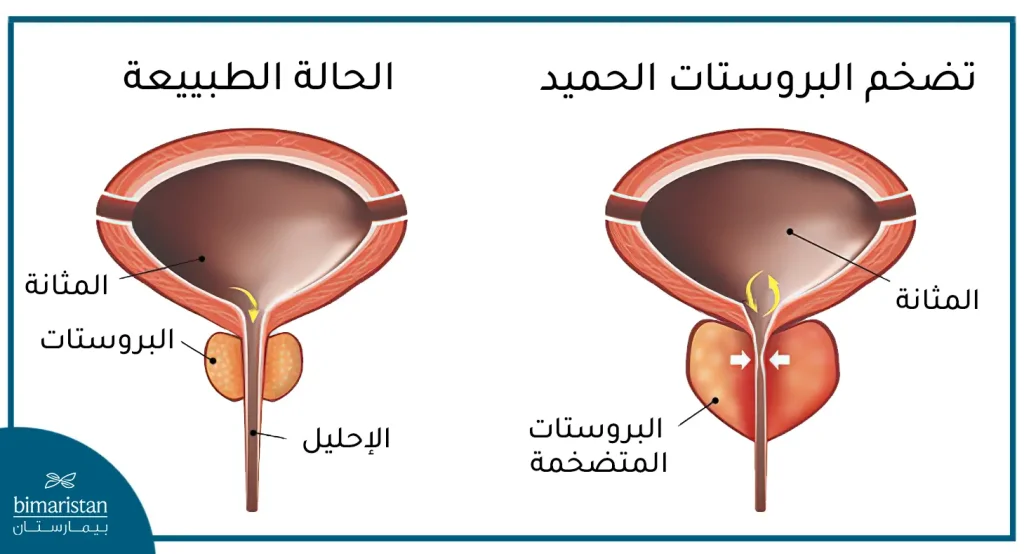 تضخم البروستات عند الرجال (Bph) بالمقارنة مع الحالة الطبيعية