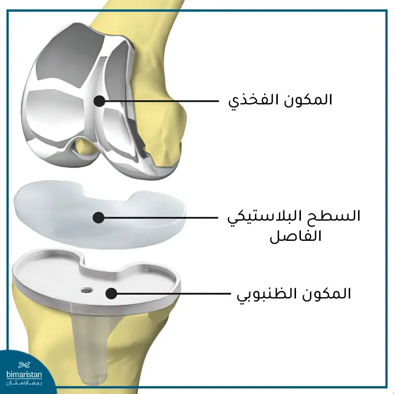 أجزاء مفصل الركبة الصناعي