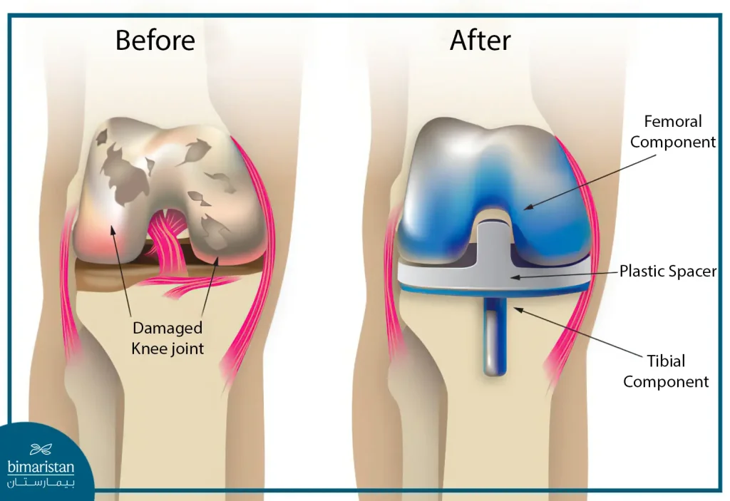 Before And After Using Knee Implant