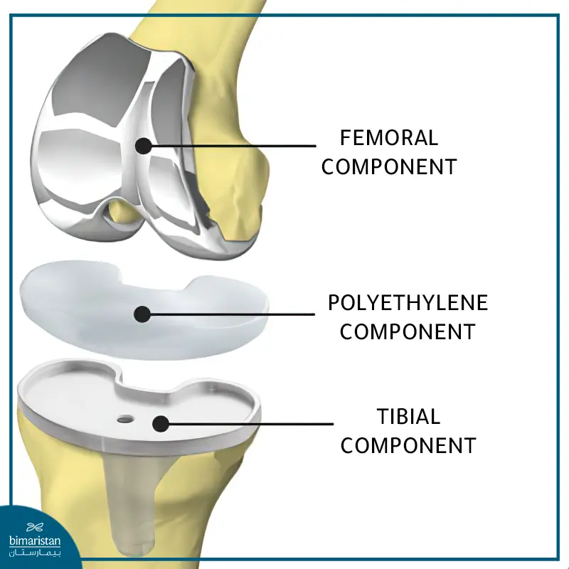 Components Of Knee Implant