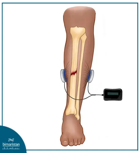 A Picture Illustrating The Application Of Electrical Stimulation For Bone Healing In Turkey.