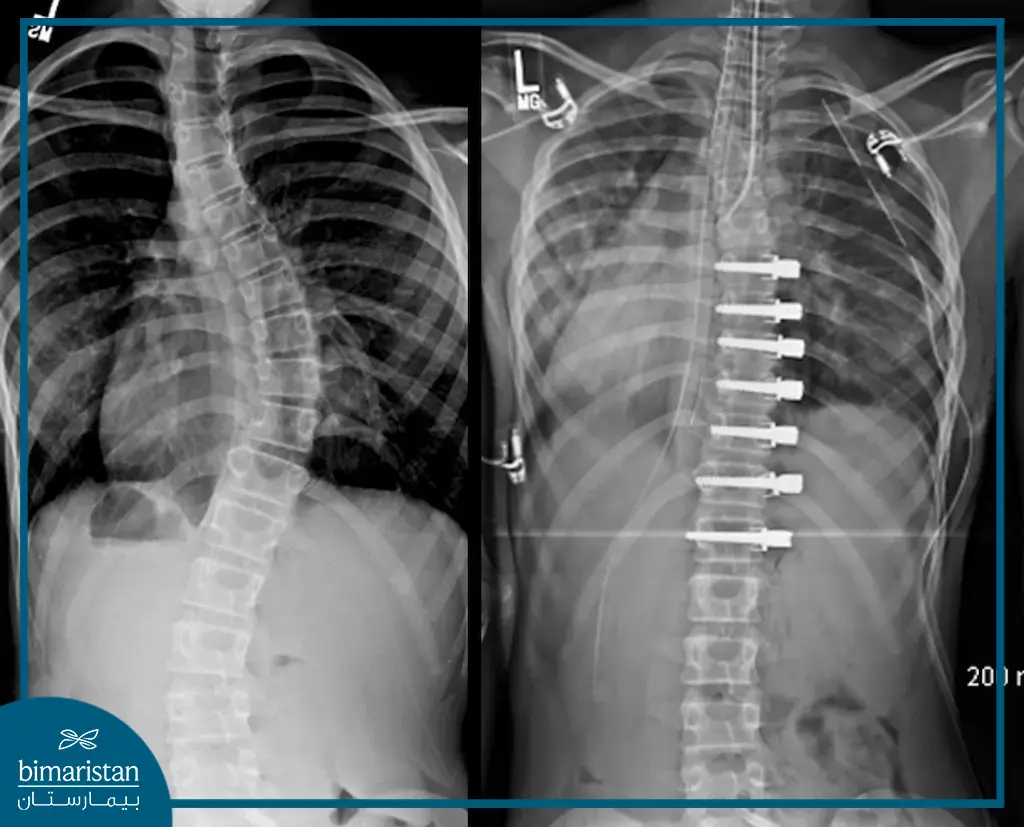 Radiograph Showing The Screws Used To Stabilize The Spine