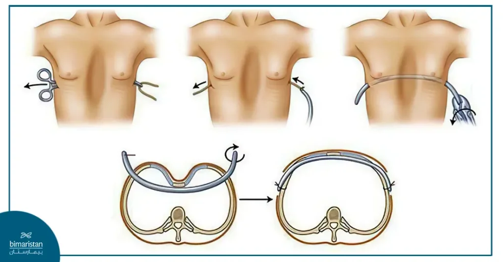 Treatment Of Pectus Excavatum In Turkey