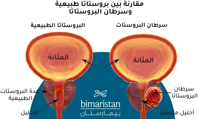 سرطان البروستاتا بالمقارنة مع البروستات الطبيعية