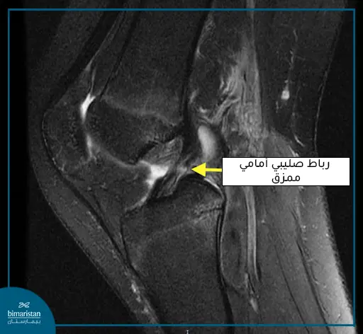 تشخيص تمزق الرباط الصليبي الأمامي في تركيا على الصور الشعاعية