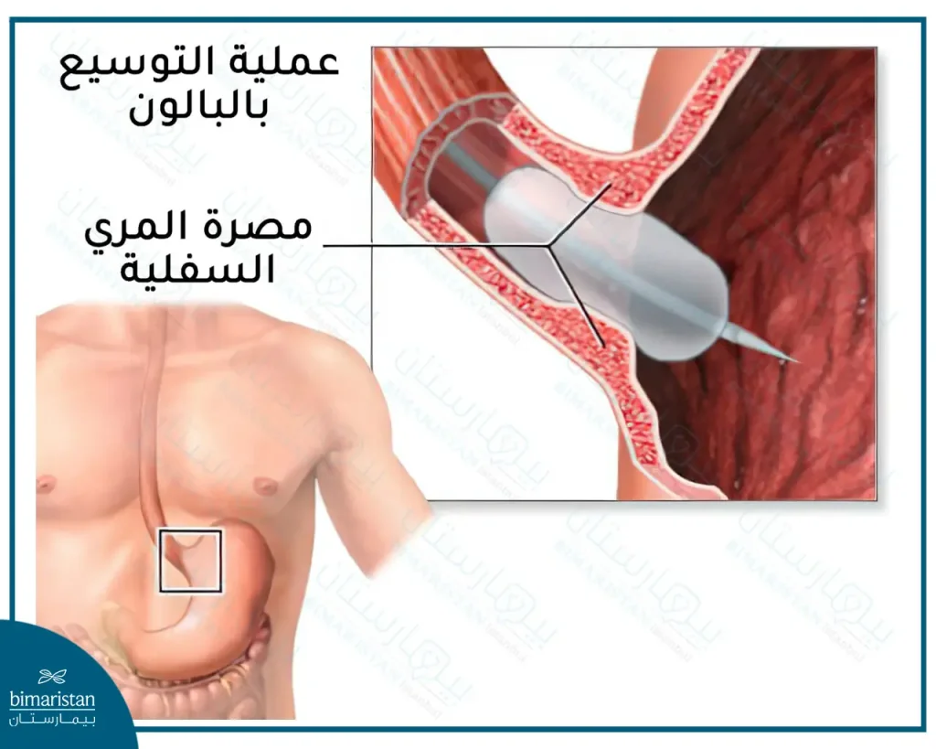 علاج الاكاليزيا عن طريق عملية التوسيع بالبالون