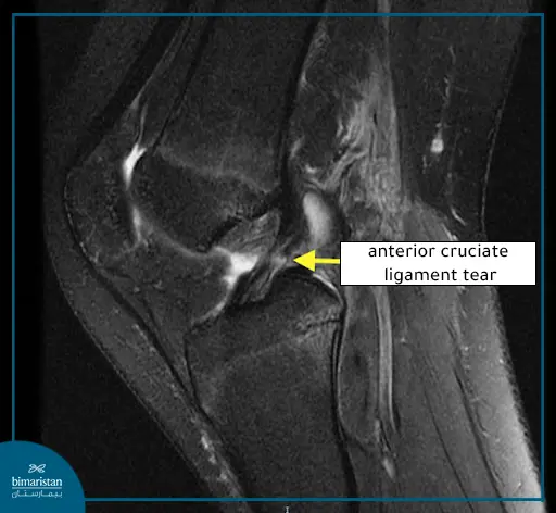 Diagnosing Anterior Cruciate Ligament (Acl) Tear In Turkey Through X-Ray Images
