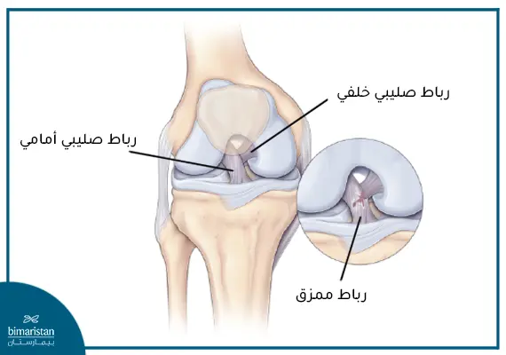 تمزق في الرباط الصليبي الأمامي - شكل رباط صليبي أمامي ممزق